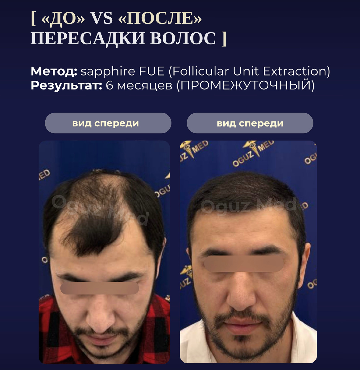 Изображение: кейс ОгузМед, до и после пересадки волос