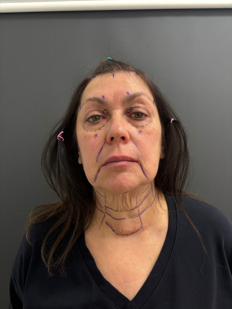 Пациентка 62 лет до операции: нанесена разметка. Хирург Остринская Т. В.