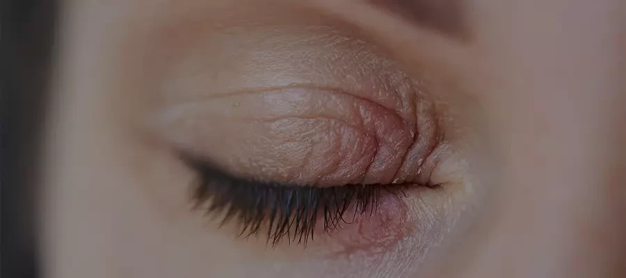 Этих клещей даже не видно: демодекоз - что это такое и как его лечить?