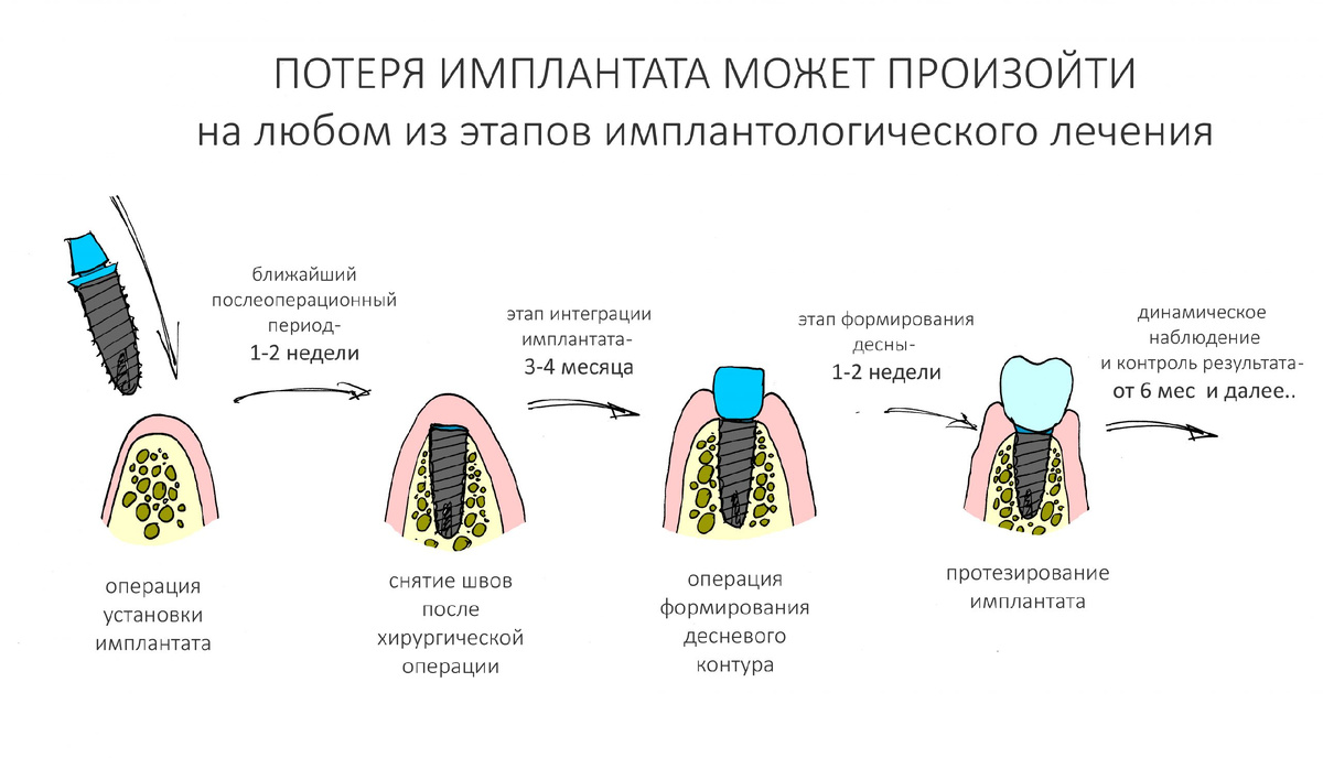 Потеря импланта