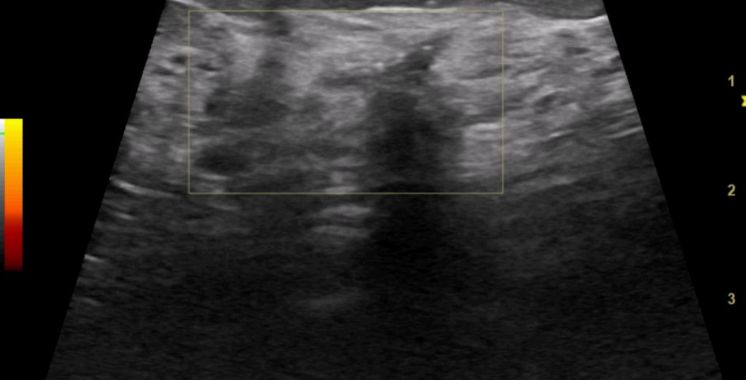Онкологический консилиум, секторальная резекция молочной железы, результат — доброкачественно.