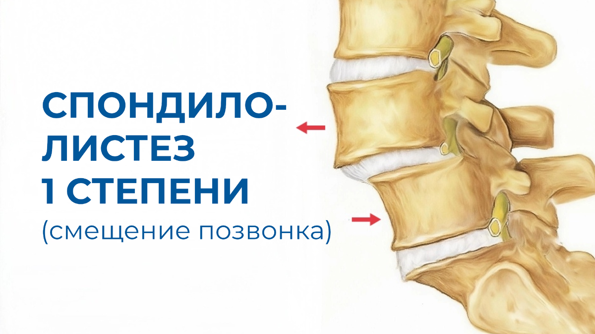 Иллюстрация спондилолистеза