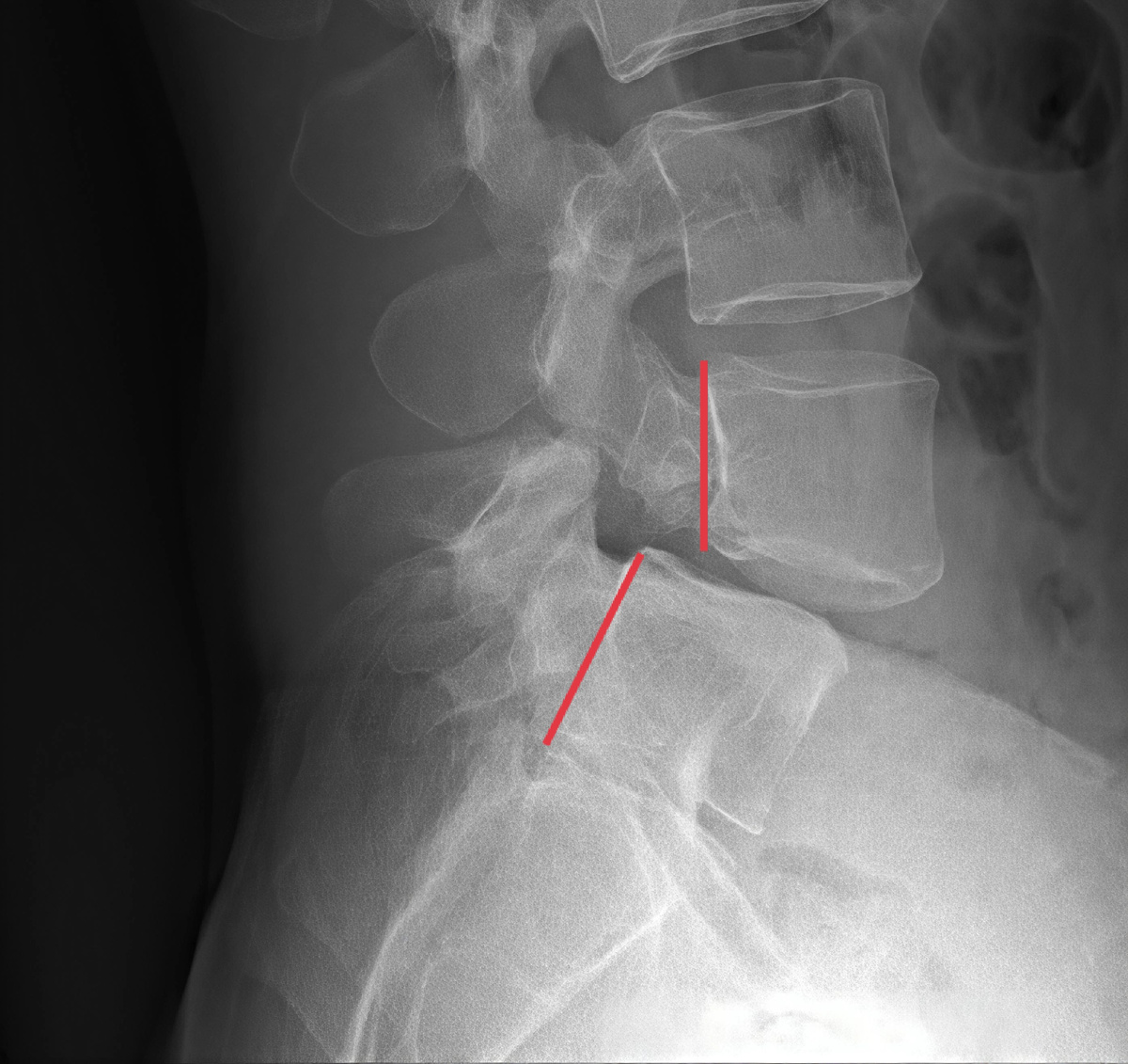 Спондилолистезт на снимке МРТ