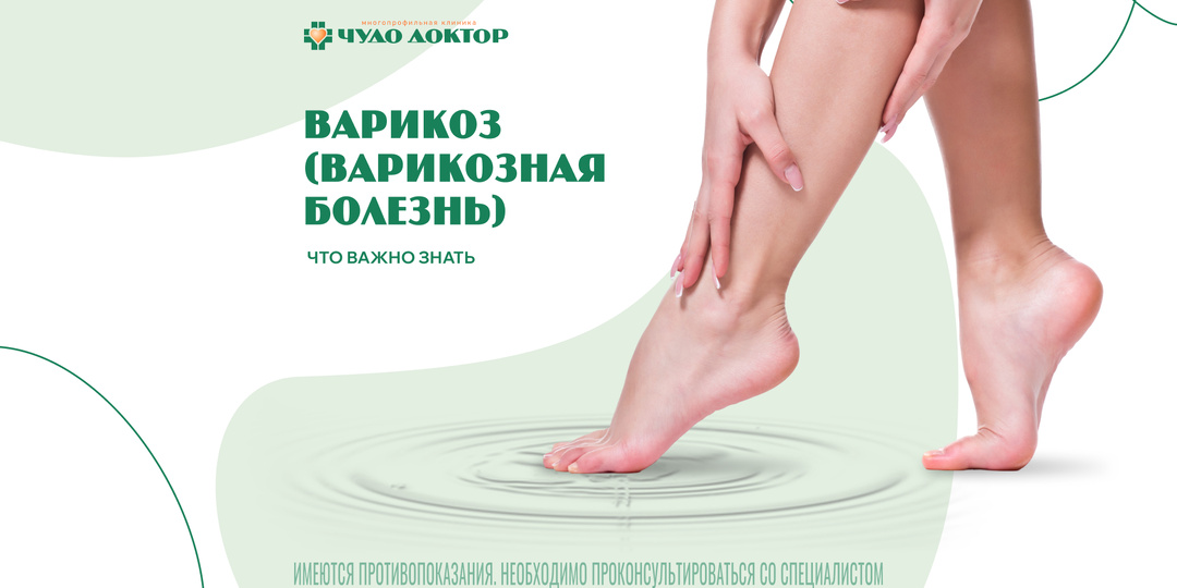 Варикоз на ногах: что важно знать