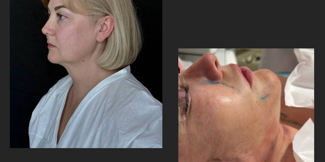 🖇Операция DEEP PLANE SMAS LIFT + верхняя блефаропластика