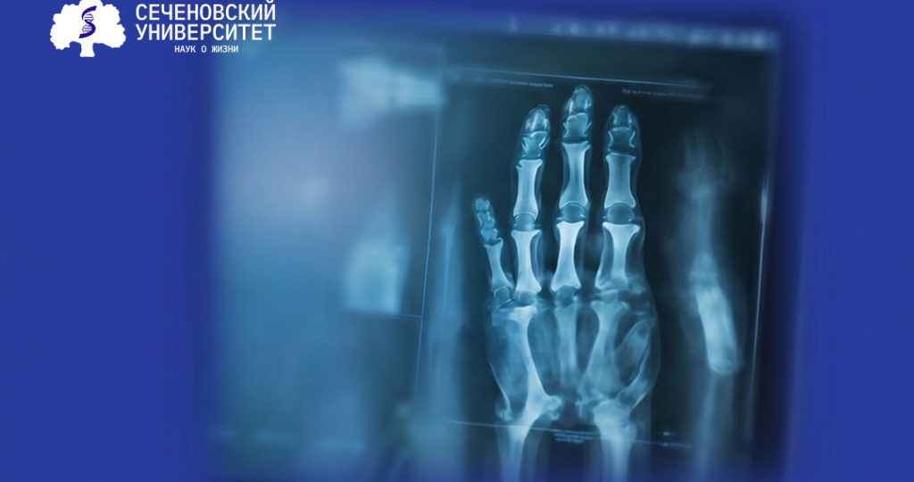 Ученые Сеченовского Университета предложили новый подход к лечению саркомы Юинга, устойчивой к химиотерапии