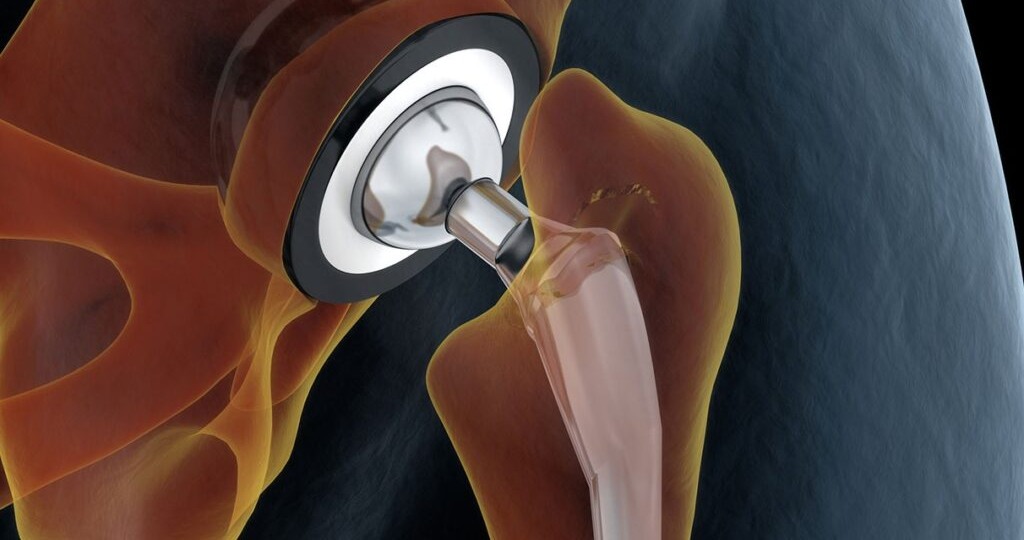 Обычные кухонные специи способны творить чудеса при замене сустава