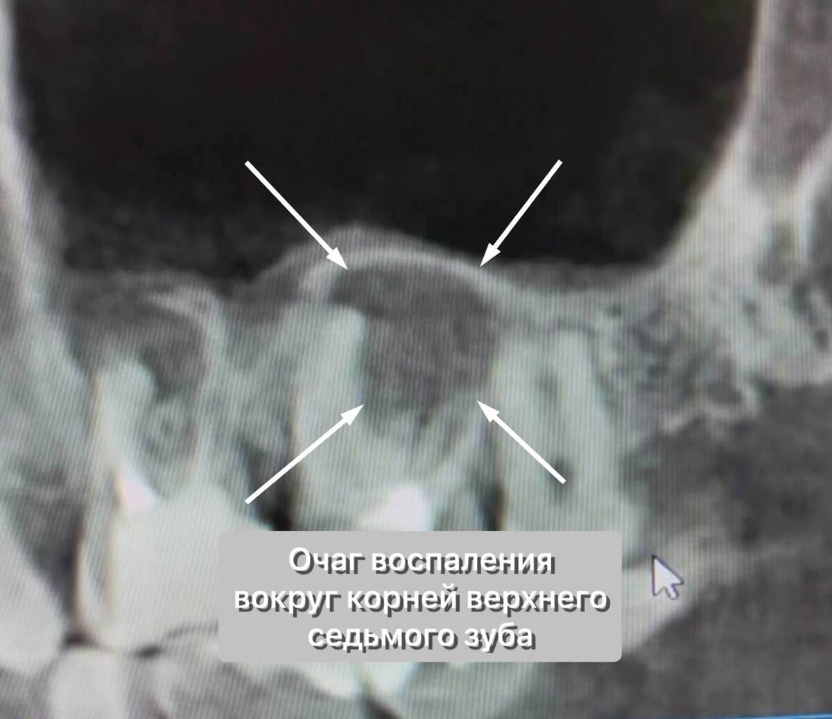 КТ 2.7 зуба - периодонтит