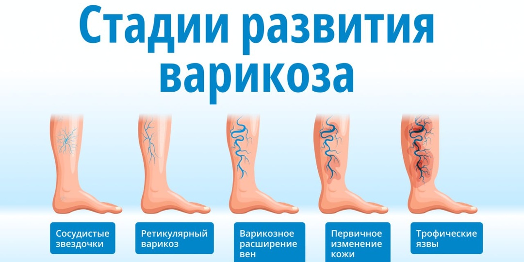 Симптомы Варикоза: Как Понять, Что Страдают Сосуды Ног