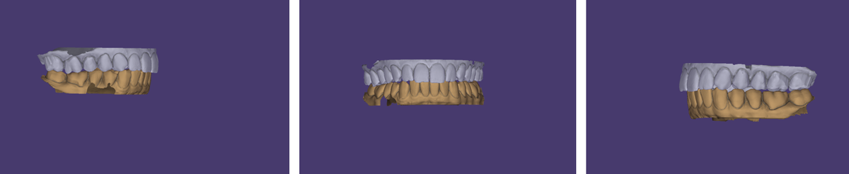 Цифровые сканы пациента для изготовления релаксационной каппы