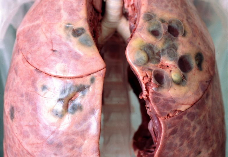 Какие болезни вызывают сигареты(курение) в лёгких?