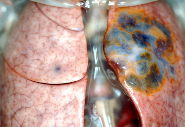 Может ли начаться воспаление лёгких из-за курения?