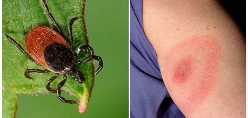 Клещевой боррелиоз (болезнь Лайма)