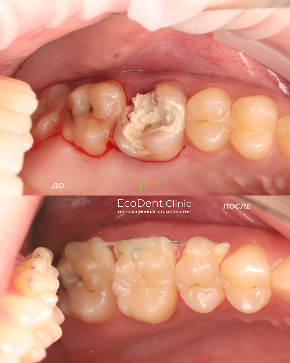 Аутотрансплантация зуба мудрости. ЭкоДент, Астрахань.
