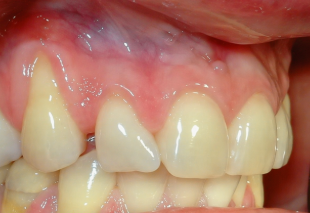  Рецессия десны