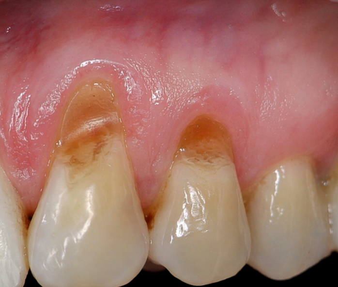 Клиновидный дефект