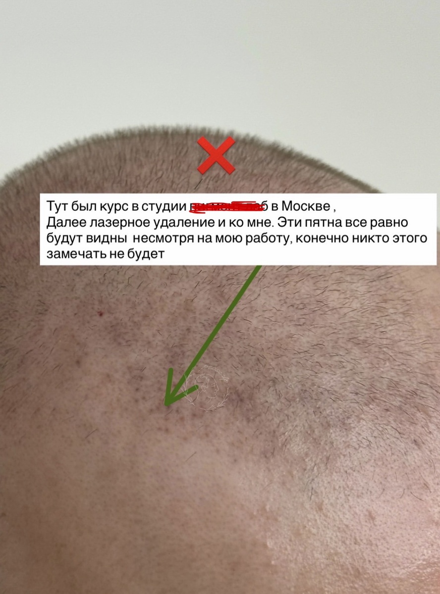 Так выглядела голова клиента до начала моей работы и после лазера.