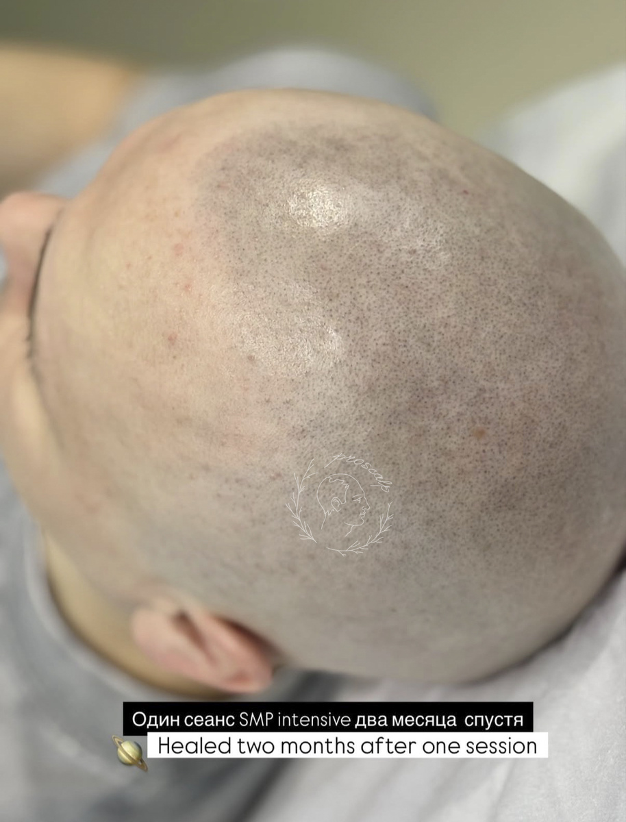 Так выглядела голова через два месяца после одного Интенсивного сеанса SMP у меня.