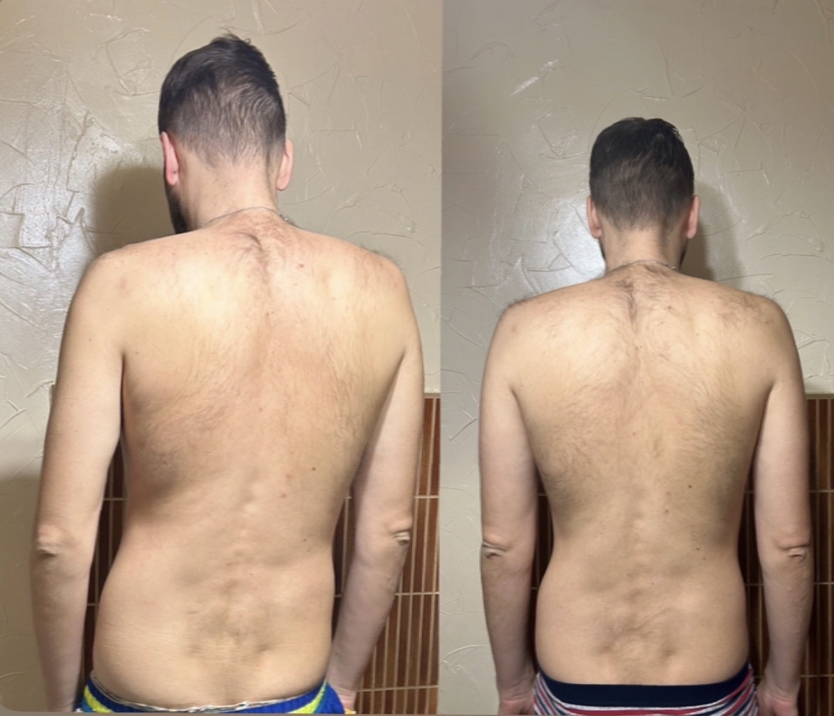 Первое фото - это каким муж пришел с работы в феврале. Второе - спустя пару недель и курс уколов мильгамы, обезболов и ЛФК гимнастики.