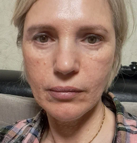 Сделала уколы красоты в лицо и шею. Рассказываю и показываю!