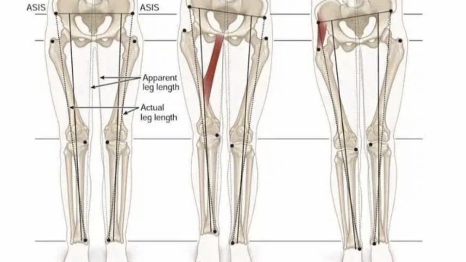 РАЗНАЯ ДЛИНА НОГ - ТАК ЛИ ВАЖНА?