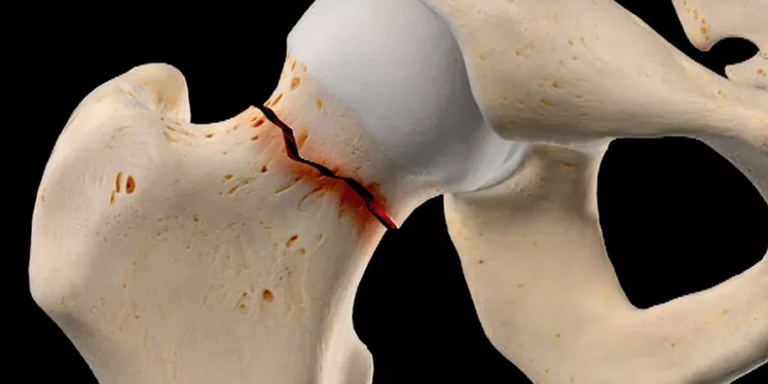 Почему ломается шейка бедра и как этого не допустить