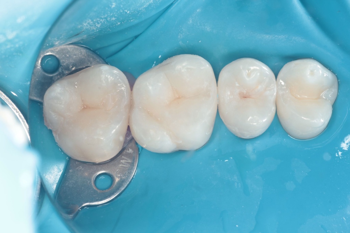 Промежуточный этап лечения