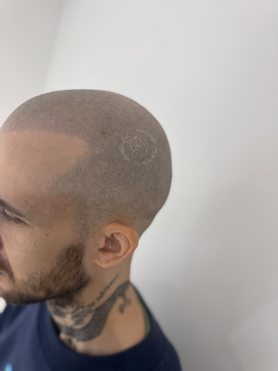 Результат SMP спустя 24 месяца после процедур.