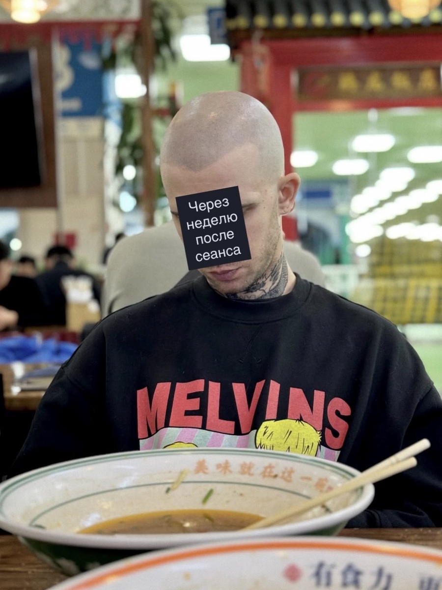 Тут через неделю после сеанса. Обратите внимание на мягкость линии роста волос — абсолютная естественность.