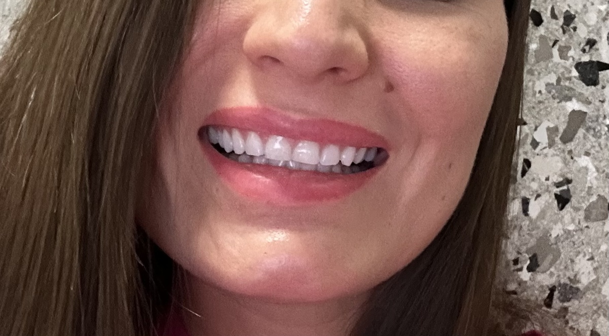 Моё отбеливание - результат на второй день после процедуры