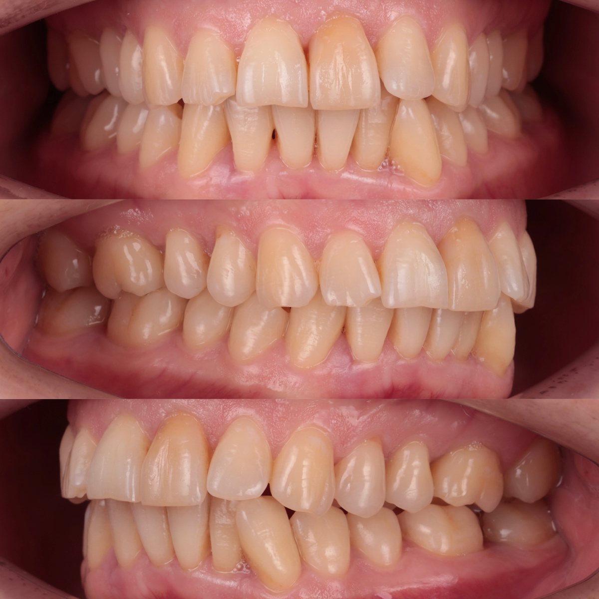 До отбеливания Zoom 4