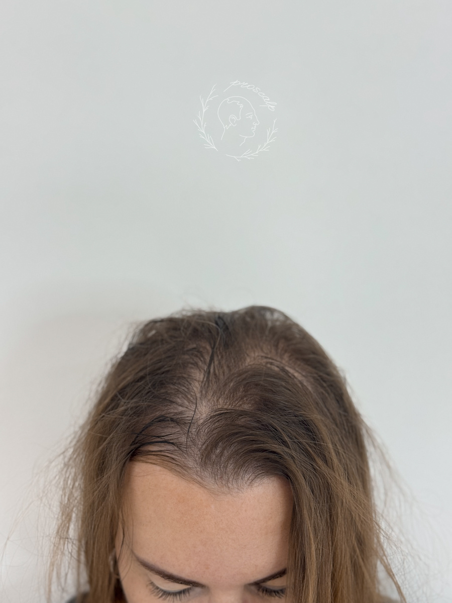 С проблемой просвечивающей кожи головы сталкиваются многие женщины. Главная задача — убрать контраст.