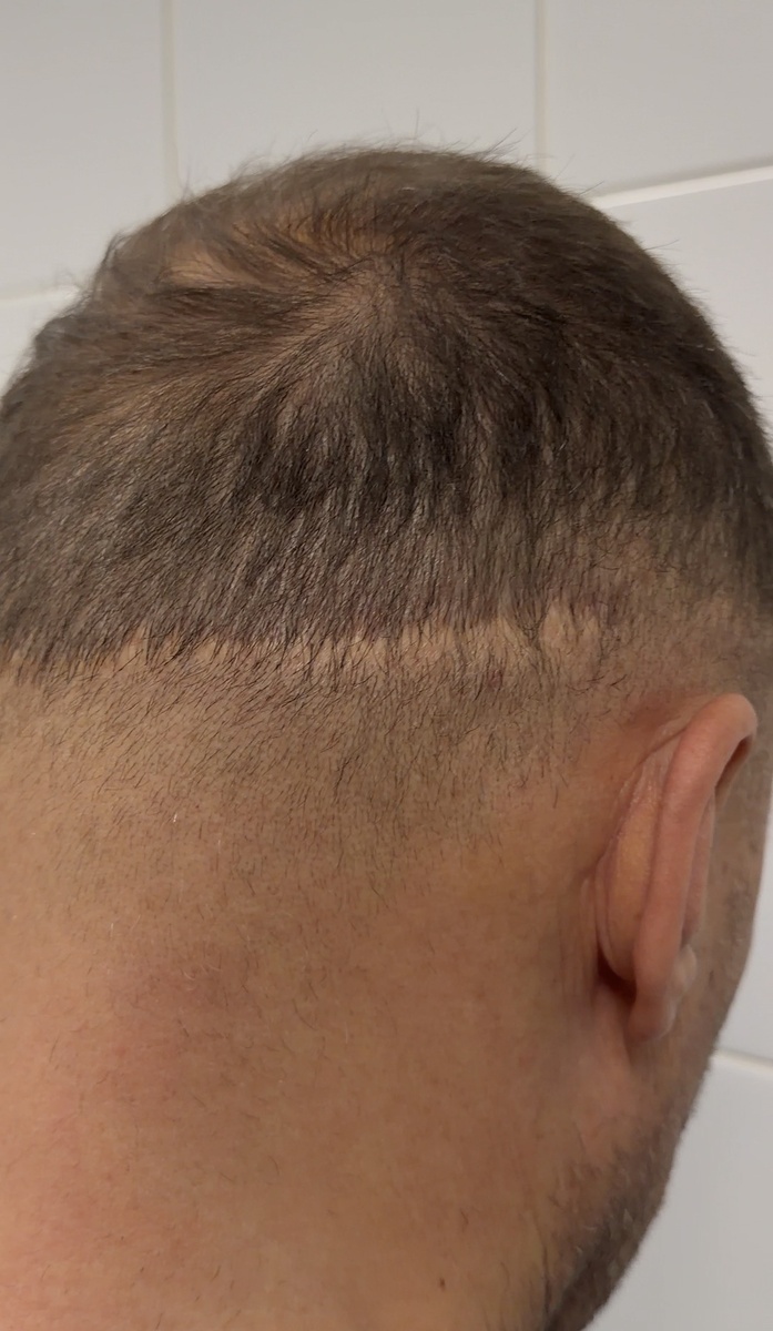 Линейный рубец после пересадки методом STRIP. Короткая стрижка с таким шрамом привлекает слишком много лишнего внимания.