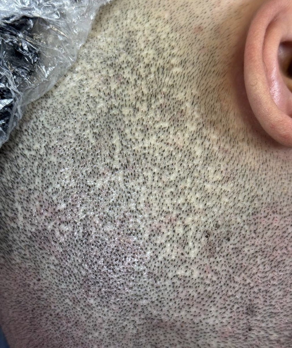 Те самые «невидимые» микро-рубцы после метода FUE. Донорская зона выглядит разреженной и пятнистой.