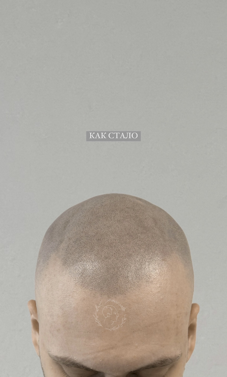 Эффект бритой головы после курса микропигментации (SMP). Пигмент выглядит абсолютно реалистично.