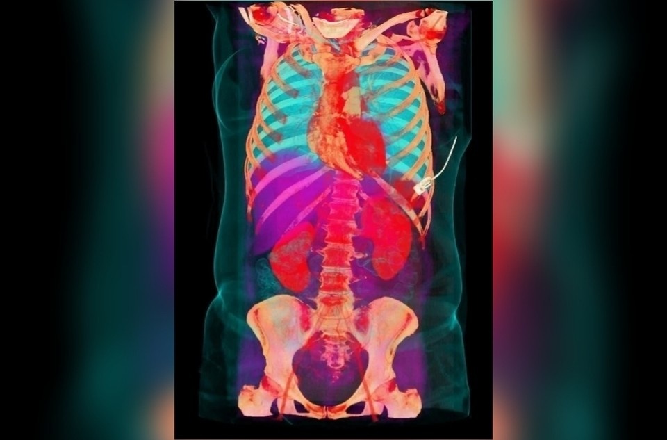    Врачи в Нижнем Новгороде спасли 29-летнюю девушку с тремя инфарктами. Фото: ГБУЗ НО НОКБ им Н. А. Семашко