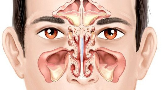 Гайморит. Изображение Яндекс Картинки
