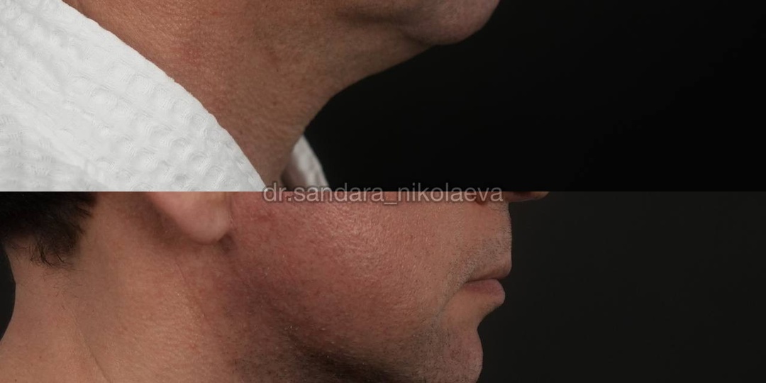 Полгода после мужского фейслифтинга