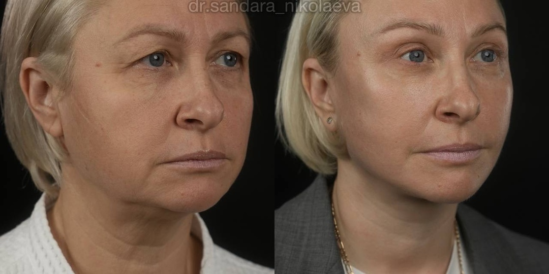 3 месяца после фейслифтинга, лобно-височного лифтинга в сочетании с верхней блефаропластикой