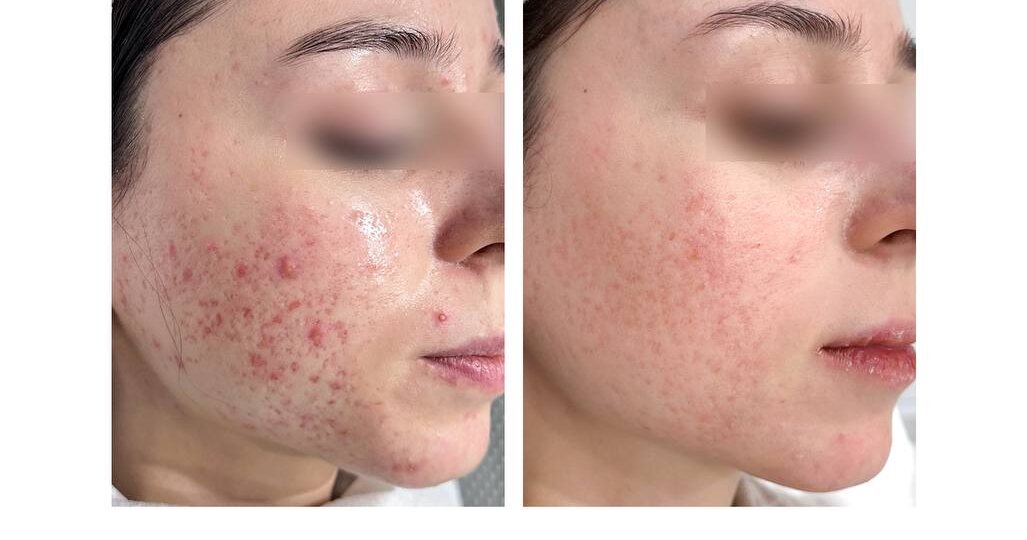 Лечение акне — это системная работа с причиной и последствиями состояния кожи