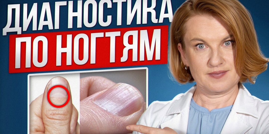 НОГТИ - предвестники БОЛЕЗНЕЙ. Диагностика болезней по ногтям