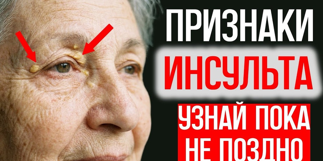 Симптомы Инсульта, Которые Появляются За Дни До Приступа