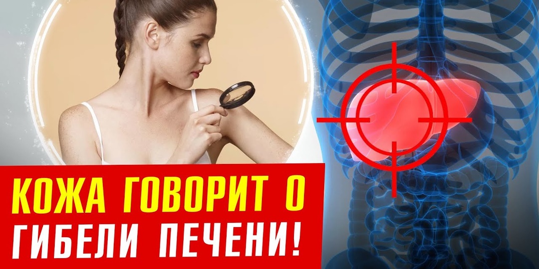 Симптомы проблем Печени, Которые Видны На Коже