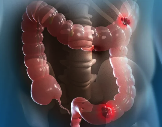 🟢 Симптомы рака кишечника: первые не значит ранние