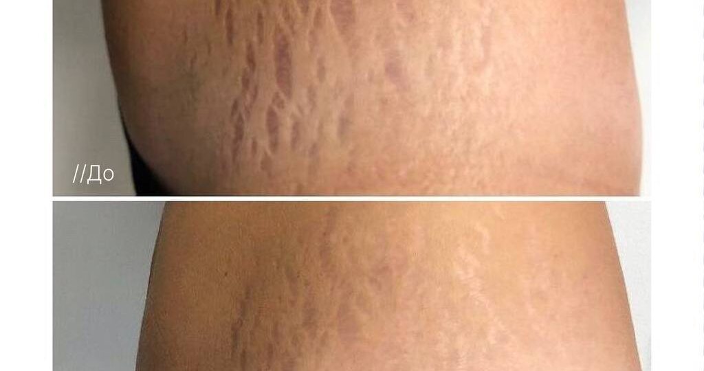 Растяжки — не приговор