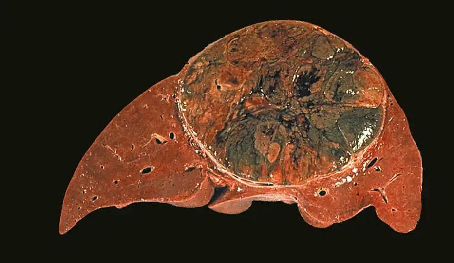 Опасна ли жировая болезнь печени с точки зрения рака?