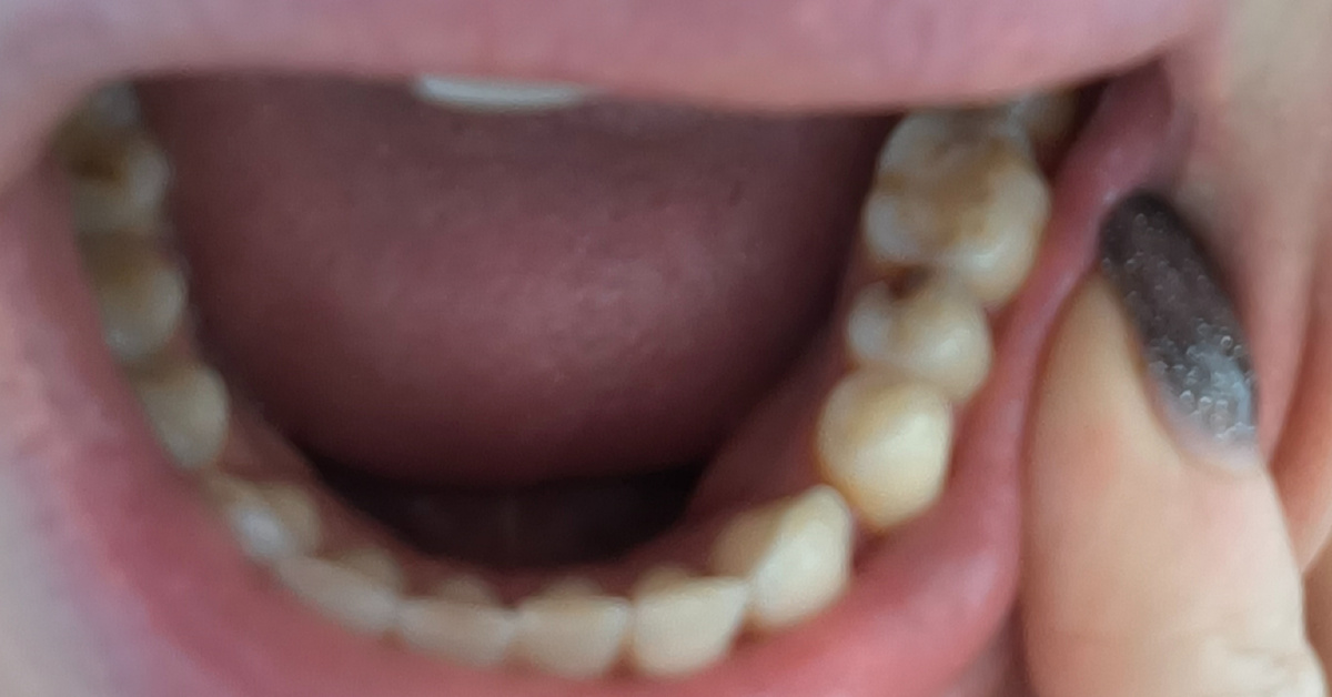 Мои нижние зубы "до". 