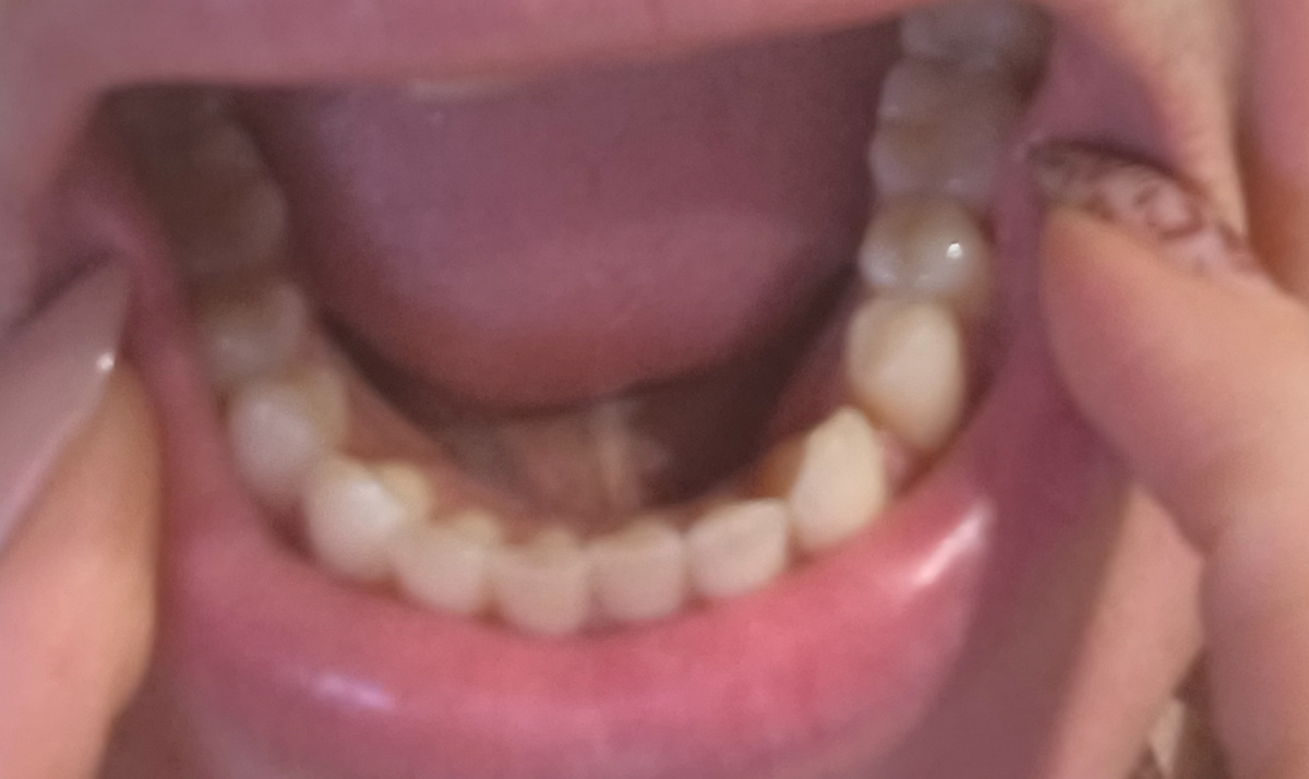 Результат после лечения четырех зубов