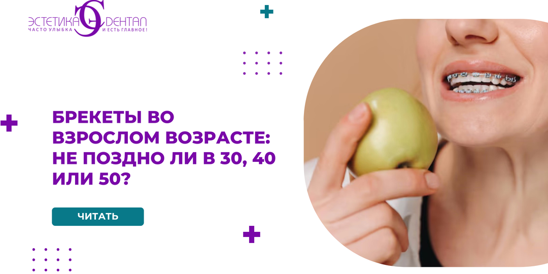 Брекеты во взрослом возрасте: не поздно ли в 30, 40 или 50?