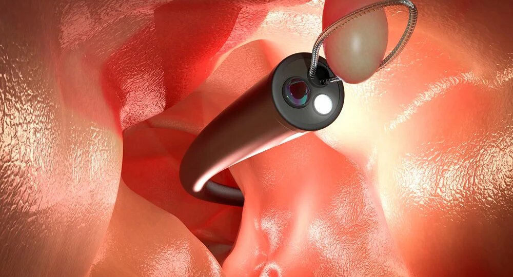 Про полипы в кишечнике